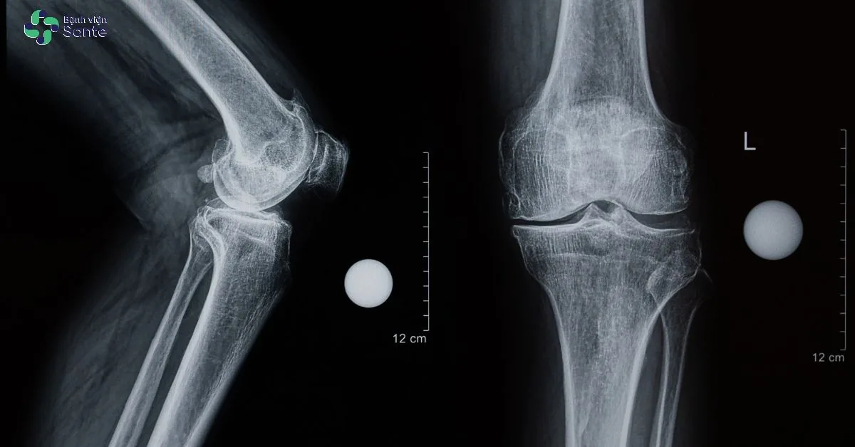심각한 관절강 협착 및 뚜렷한 골극 형성이 관찰되는 말기 퇴행성 슬관절염 X-ray 영상
