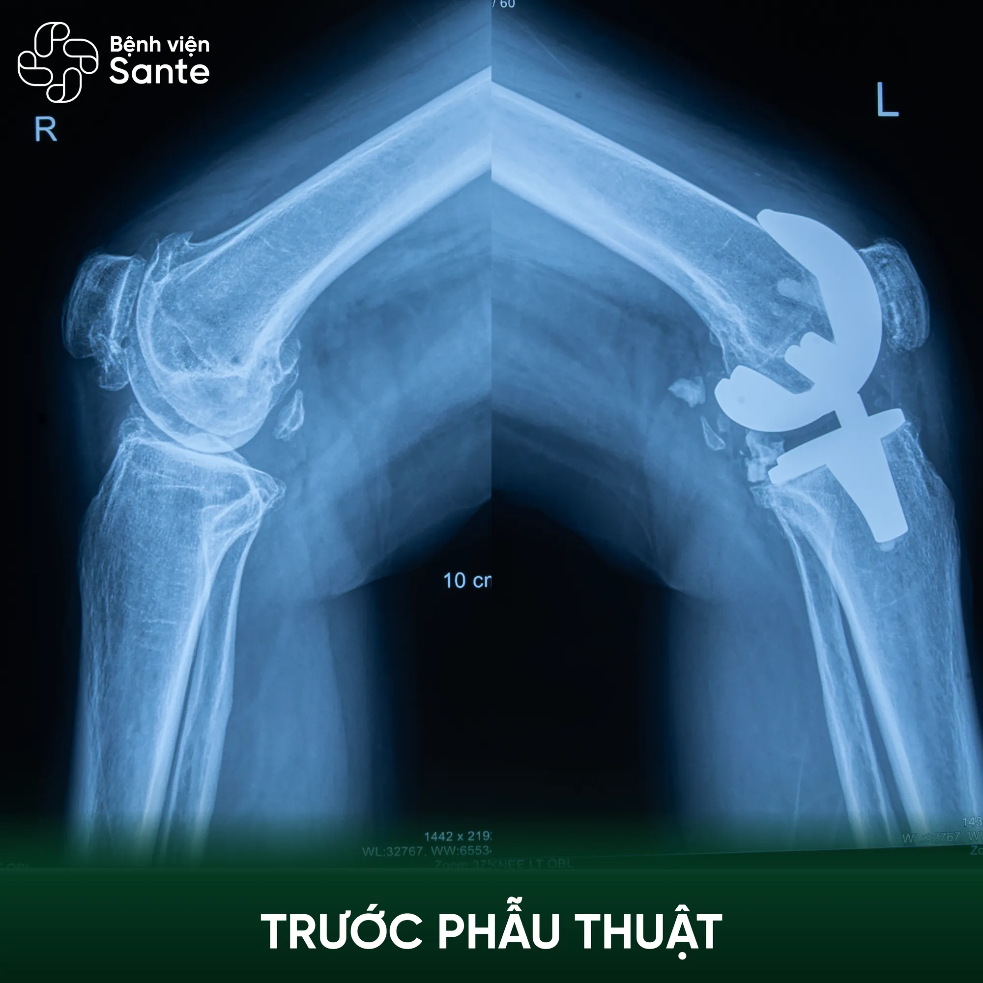 수술 전 Sante 병원에서 촬영한 Huong 님의 무릎 X-ray 영상으로, 중증 퇴행성 관절염 소견이 관찰됨