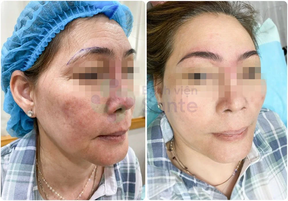 Bệnh viện Sante - Phun xăm thẩm mỹ (Hình 2)