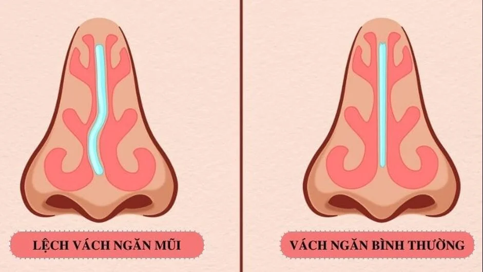 Bệnh viện Sante - LỆCH VÁCH NGĂN MŨI KHI NÀO CẦN PHẪU THUẬT ? (Hình 2) Bệnh viện Sante - LỆCH VÁCH NGĂN MŨI KHI NÀO CẦN PHẪU THUẬT ? (Hình 2)
