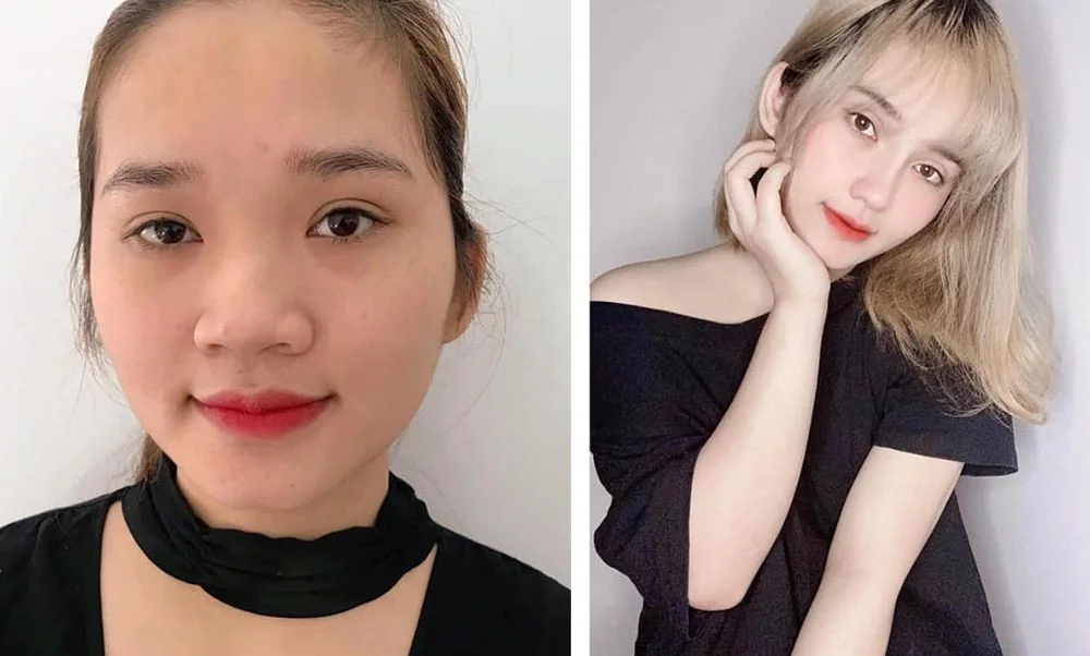 Bệnh viện Sante - Phẫu thuật thẩm mỹ thay đổi hoàn toàn gương mặt (Hình 3) Bệnh viện Sante - Phẫu thuật thẩm mỹ thay đổi hoàn toàn gương mặt (Hình 3)