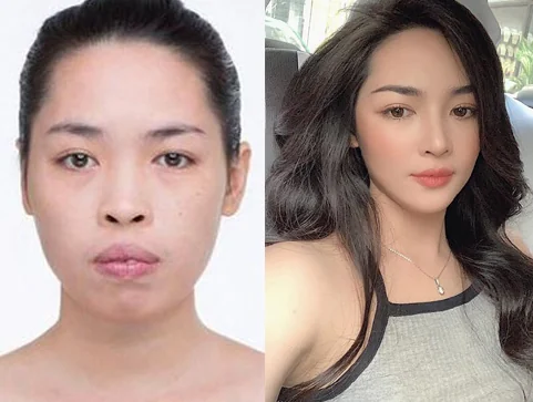 Bệnh viện Sante - Phẫu thuật thẩm mỹ thay đổi hoàn toàn gương mặt (Hình 5) Bệnh viện Sante - Phẫu thuật thẩm mỹ thay đổi hoàn toàn gương mặt (Hình 5)