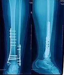 Kết hợp xương nẹp vis Kết hợp xương nẹp vis - Bệnh viện SANTE Bình Thạnh, TP.HCM