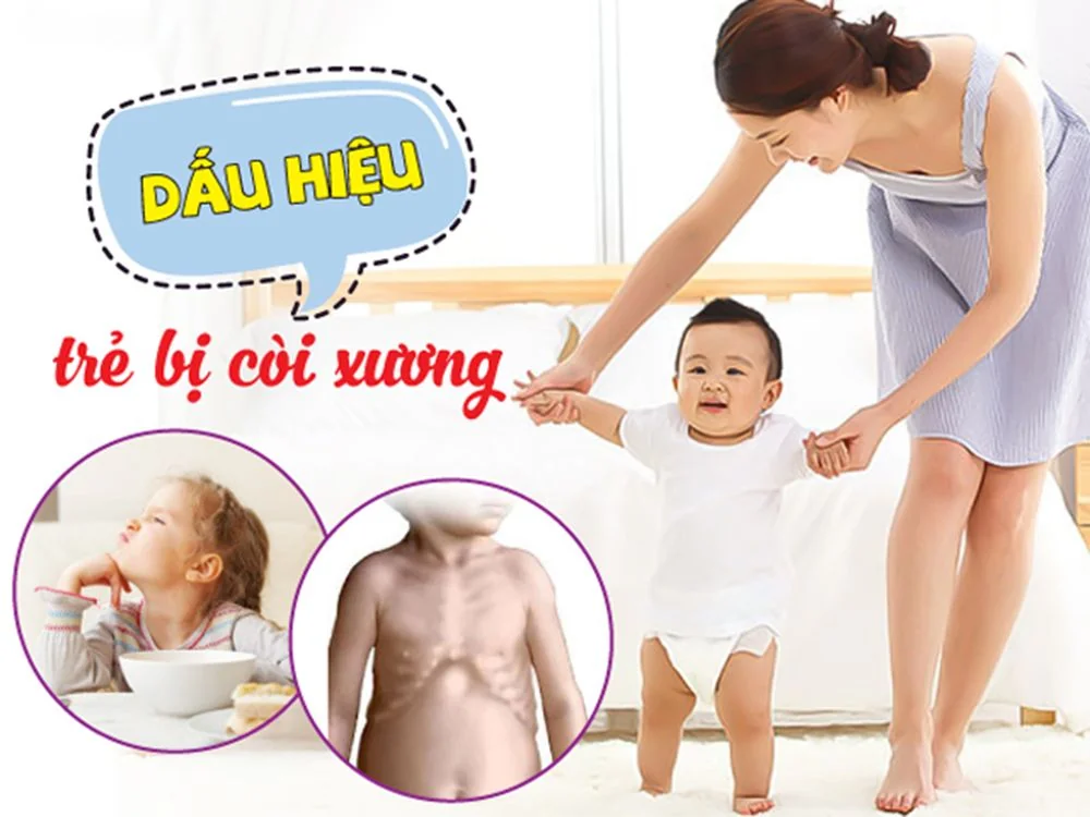 Bệnh viện Sante - Còi xương là bệnh như thế nào? Triệu chứng và cách chẩn đoán (Hình 3) Bệnh viện Sante - Còi xương là bệnh như thế nào? Triệu chứng và cách chẩn đoán (Hình 3)