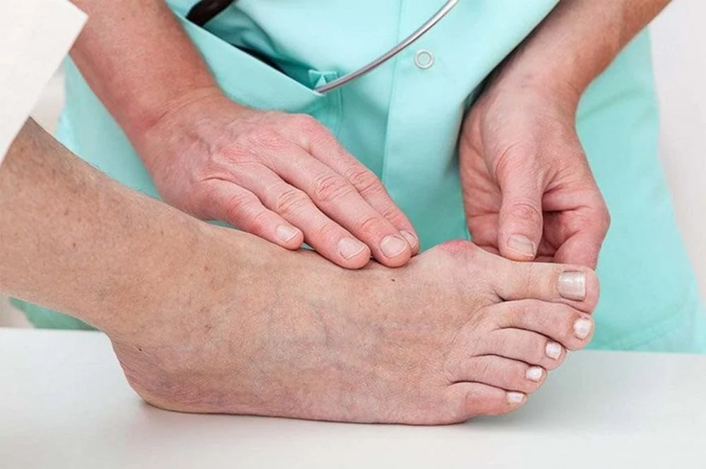 Bệnh viện Sante - Gout - Không còn là bệnh của người giàu