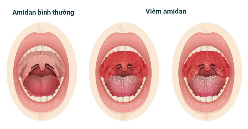 Bệnh viện Sante - Nguyên nhân nào dẫn đến đau họng? Triệu chứng_ cách chữa trị (Hình 4) Bệnh viện Sante - Nguyên nhân nào dẫn đến đau họng? Triệu chứng_ cách chữa trị (Hình 4)