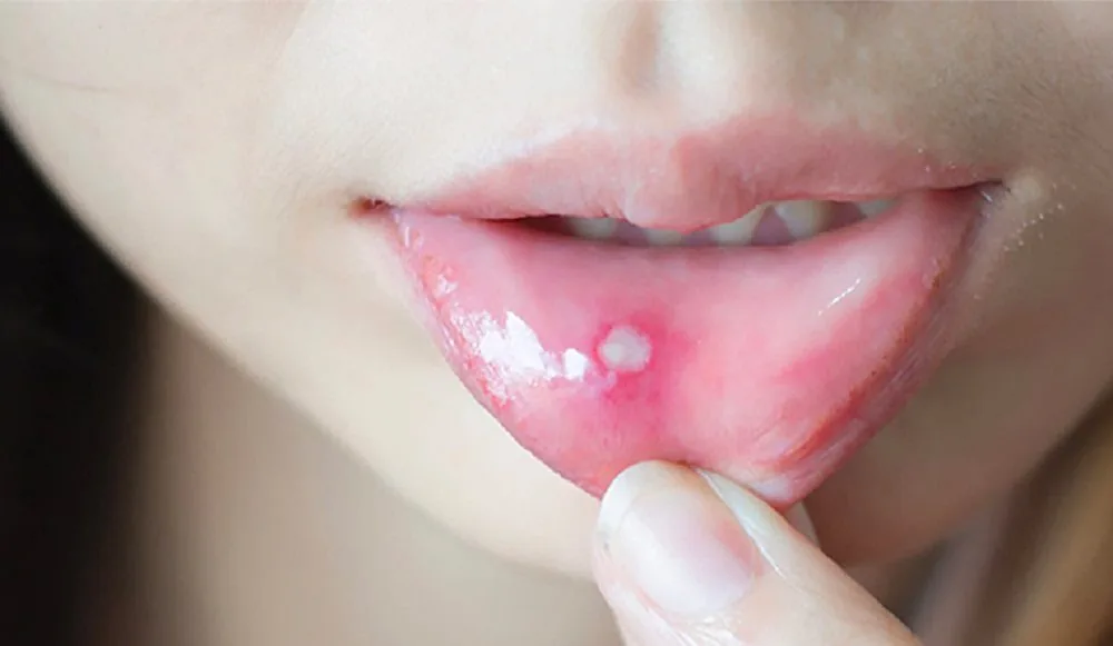 Bệnh viện Sante - Nhiệt miệng có nguy hiểm không? (Hình 2) Bệnh viện Sante - Nhiệt miệng có nguy hiểm không? (Hình 2)