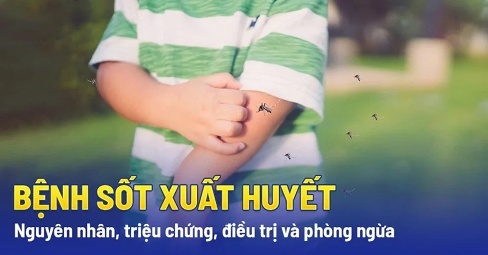 Bệnh viện Sante - Những điều cần biết về sốt xuất huyết (Hình 2)