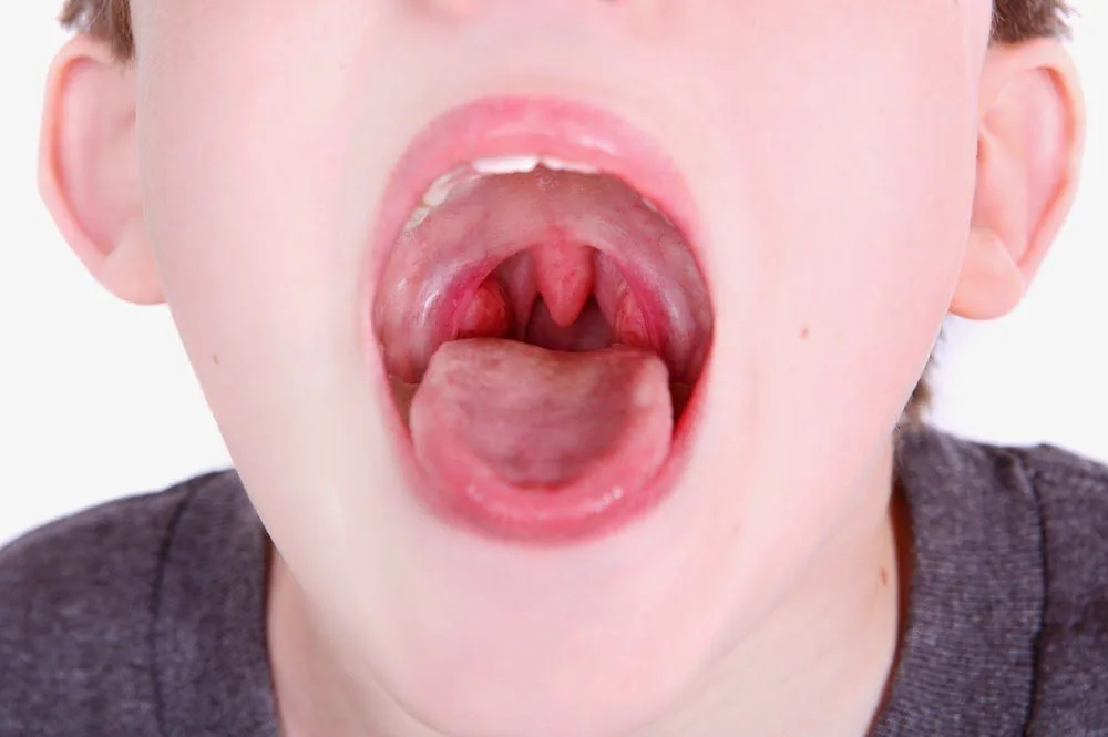 Bệnh viện Sante - Viêm amidan là gì? Nguyên nhân_ triệu chứng và cách điều trị (Hình 2) Bệnh viện Sante - Viêm amidan là gì? Nguyên nhân_ triệu chứng và cách điều trị (Hình 2)