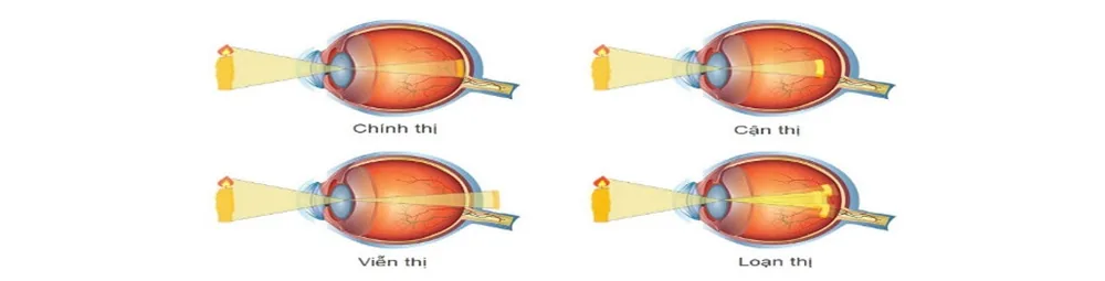 Những bệnh lý nguy hiểm thường gặp ở mắt ai cũng nên cảnh giác - Hình 4 - Bệnh viện SANTE Bình Thạnh, TP.HCM Những bệnh lý nguy hiểm thường gặp ở mắt ai cũng nên cảnh giác - Hình 4 - Bệnh viện SANTE Bình Thạnh, TP.HCM