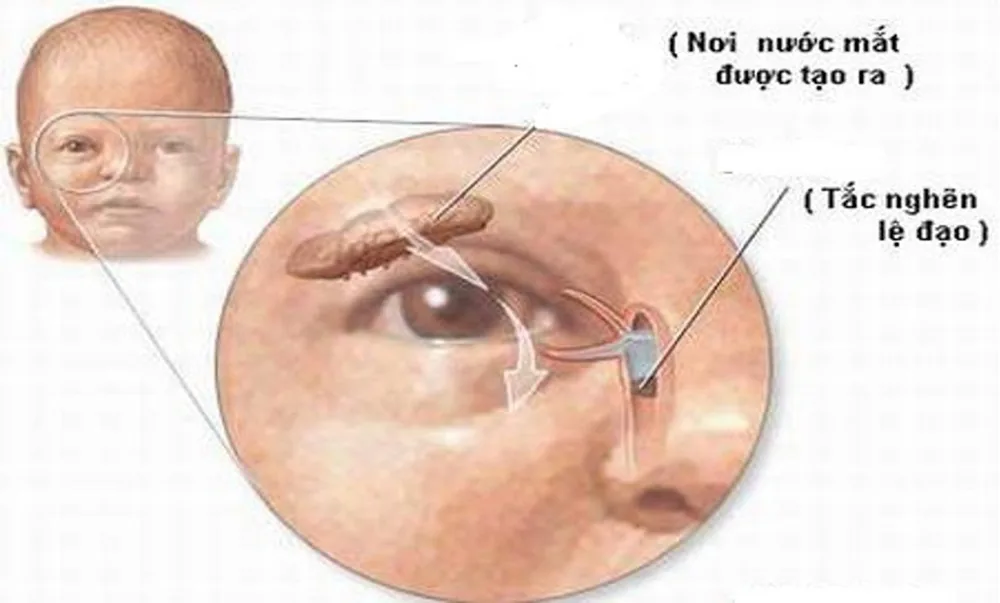 Những bệnh lý nguy hiểm thường gặp ở mắt ai cũng nên cảnh giác - Hình 9 - Bệnh viện SANTE Bình Thạnh, TP.HCM Những bệnh lý nguy hiểm thường gặp ở mắt ai cũng nên cảnh giác - Hình 9 - Bệnh viện SANTE Bình Thạnh, TP.HCM