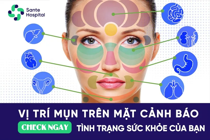 Những vị trí mụn trên khuôn mặt cảnh báo sức khỏe của bạn - Bệnh viện SANTE Bình Thạnh, TP.HCM Những vị trí mụn trên khuôn mặt cảnh báo sức khỏe của bạn - Bệnh viện SANTE Bình Thạnh, TP.HCM