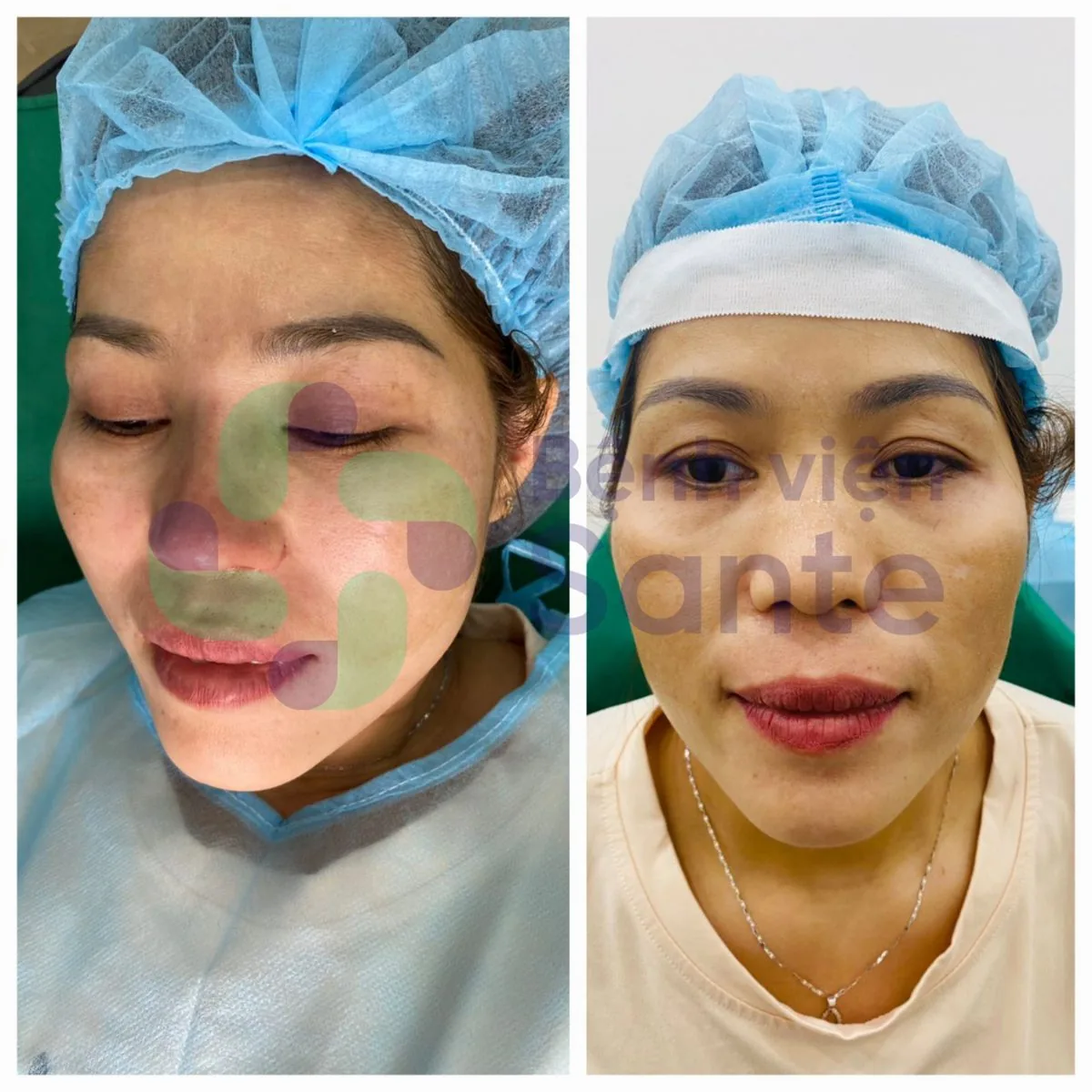 Phẫu thuật nâng mũi là gì? Bệnh viện chuyên khoa phẫu thuật nâng mũi chất lượng quốc tế HCM - Hình 2 Phẫu thuật nâng mũi là gì? Bệnh viện chuyên khoa phẫu thuật nâng mũi chất lượng quốc tế HCM - Hình 2