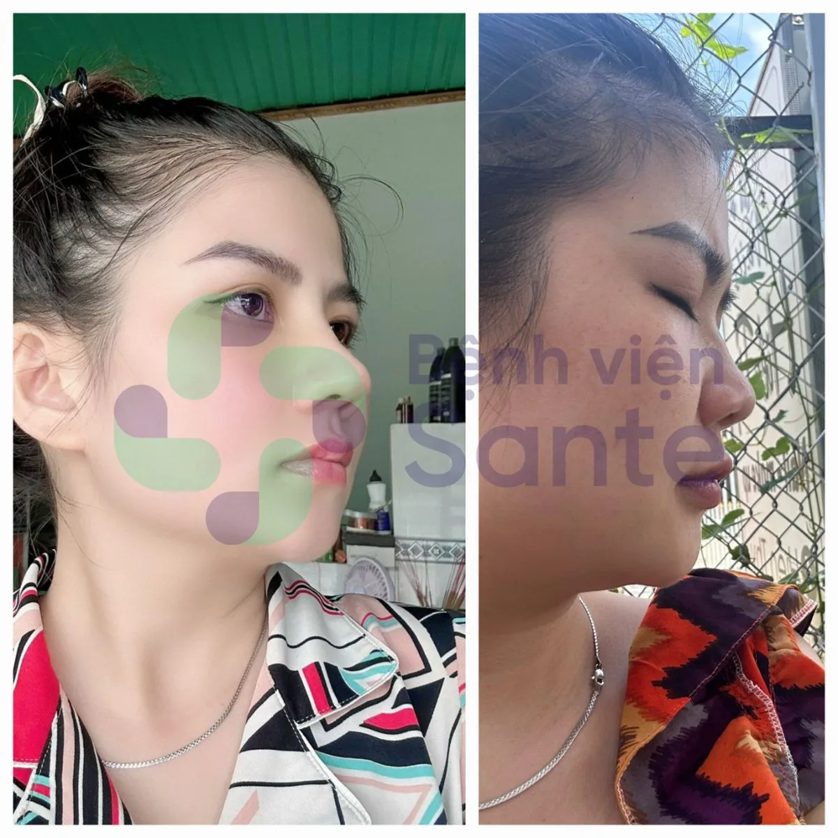 Phẫu thuật nâng mũi là gì? Bệnh viện chuyên khoa phẫu thuật nâng mũi chất lượng quốc tế HCM - Hình 3 Phẫu thuật nâng mũi là gì? Bệnh viện chuyên khoa phẫu thuật nâng mũi chất lượng quốc tế HCM - Hình 3