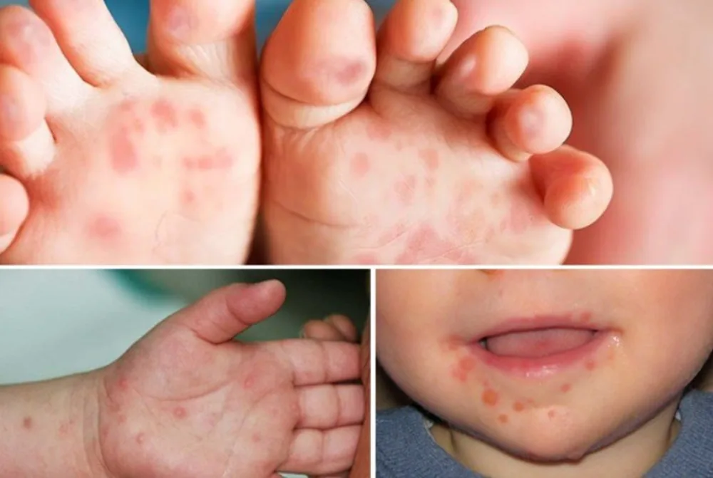 PHÒNG NGỪA BỆNH TAY CHÂN MIỆNG CHO TRẺ - Hình 2 - Bệnh viện SANTE Bình Thạnh, TP.HCM PHÒNG NGỪA BỆNH TAY CHÂN MIỆNG CHO TRẺ - Hình 2 - Bệnh viện SANTE Bình Thạnh, TP.HCM