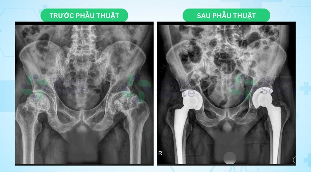 Quay lại thay khớp háng thứ 2 sau 1 tháng - Hình 2 - Bệnh viện SANTE Bình Thạnh, TP.HCM Quay lại thay khớp háng thứ 2 sau 1 tháng - Hình 2 - Bệnh viện SANTE Bình Thạnh, TP.HCM